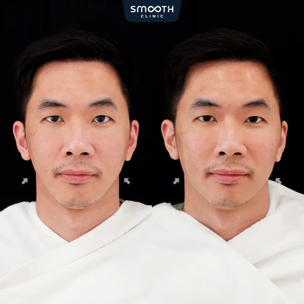 รีวิวฟิลเลอร์กรอบหน้า 1