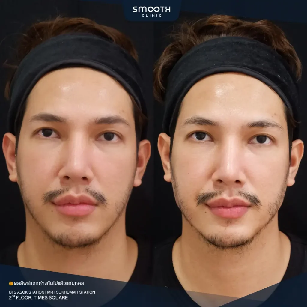 รีวิวฟิลเลอร์กรอบหน้า 2