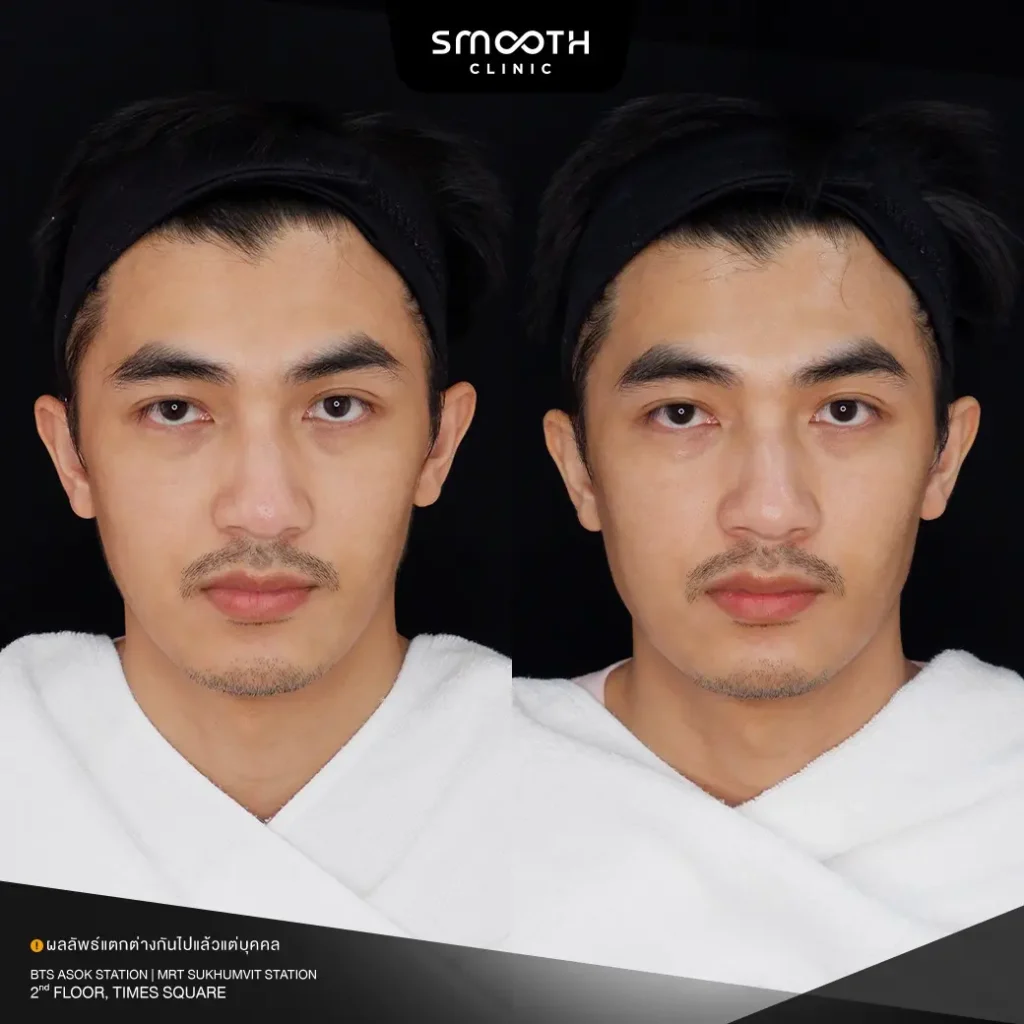 รีวิวฟิลเลอร์กรอบหน้า 3