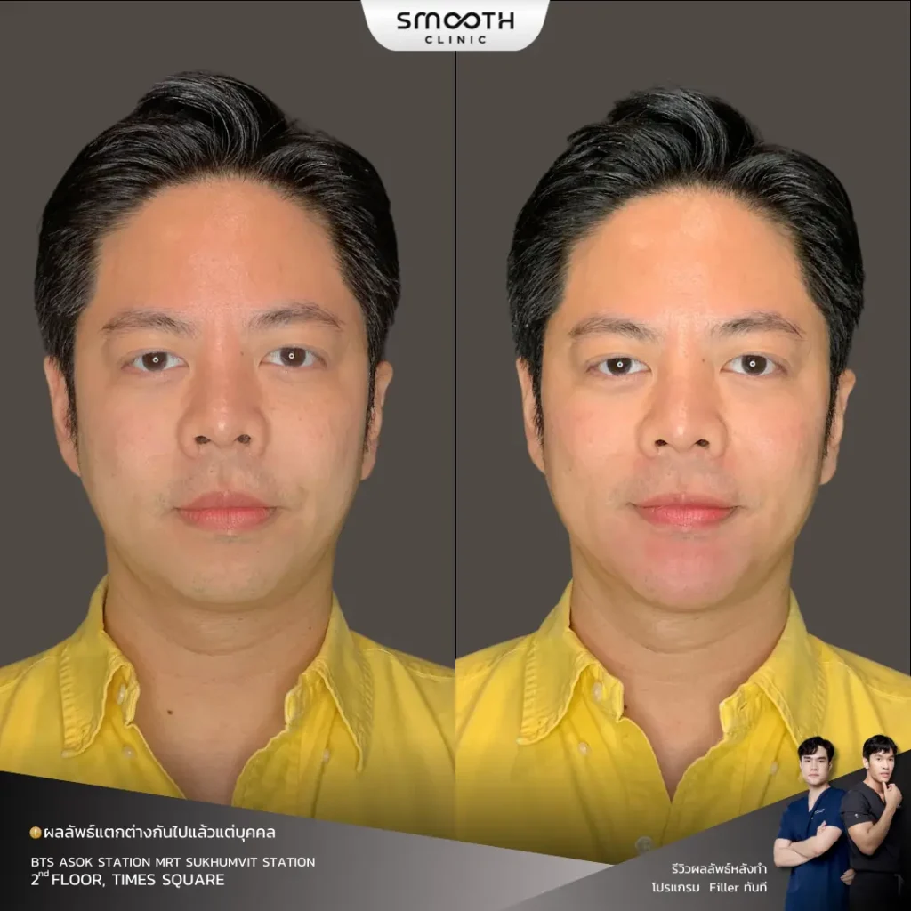 รีวิวฟิลเลอร์กรอบหน้า 4