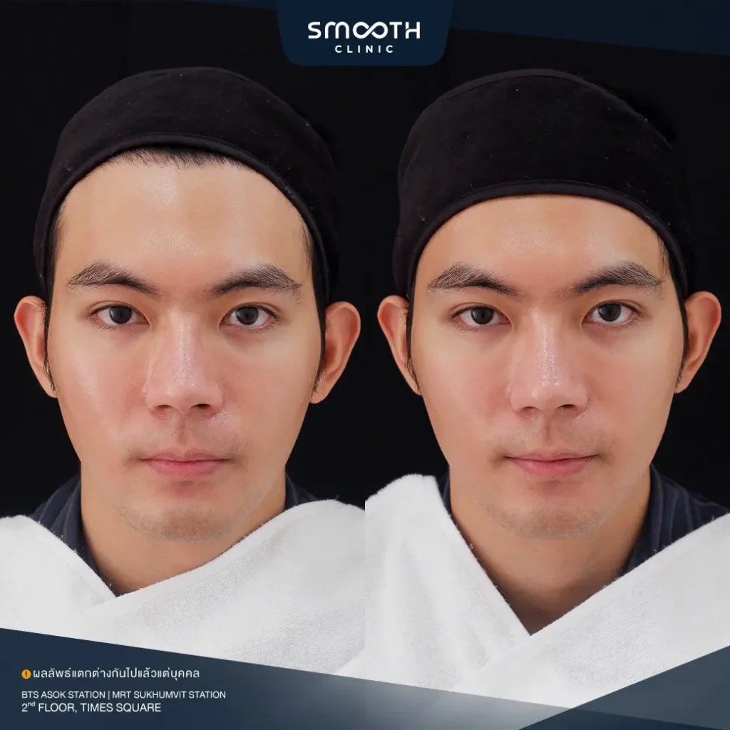 รีวิวฟิลเลอร์กรอบหน้า 5