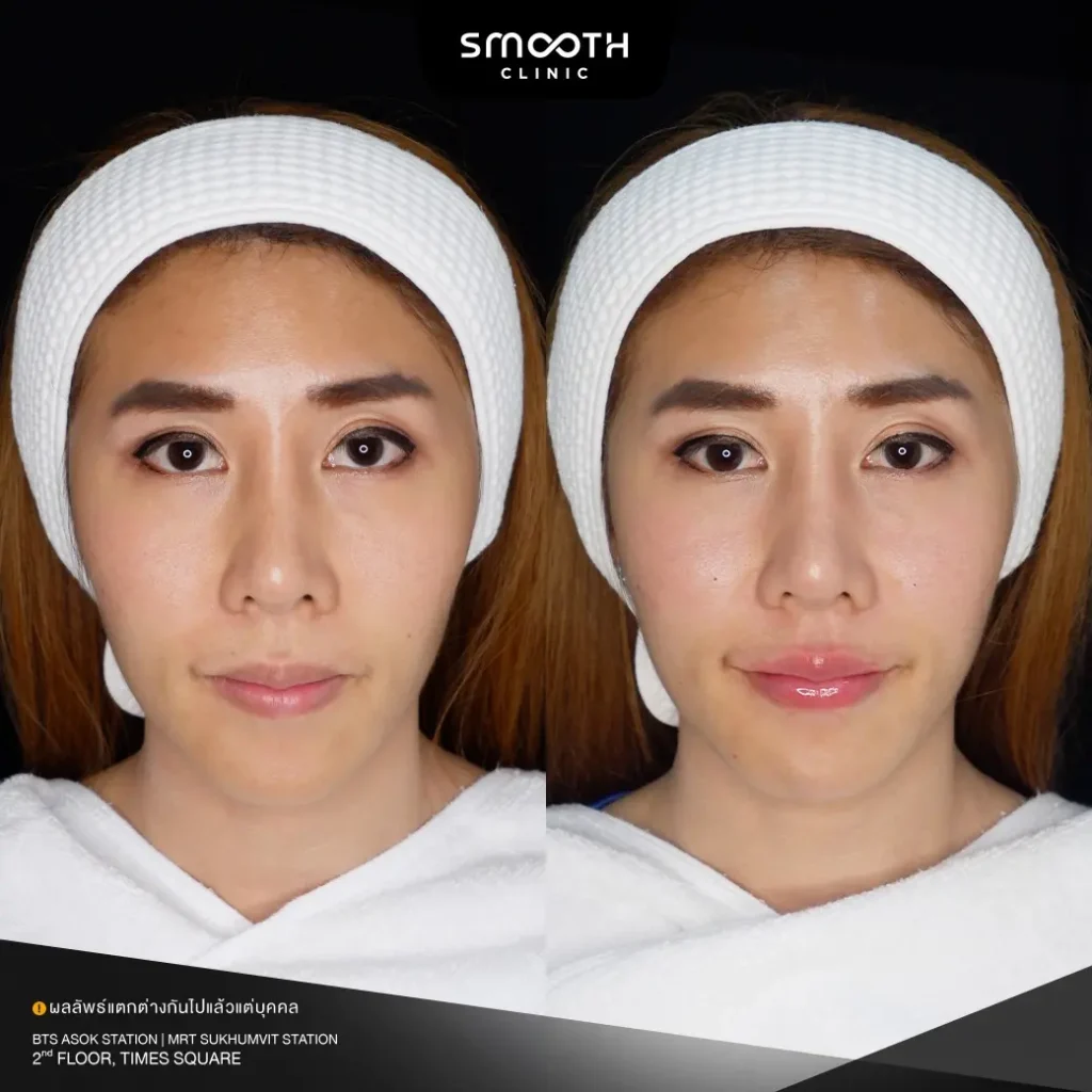 รีวิวฟิลเลอร์ปาก 1