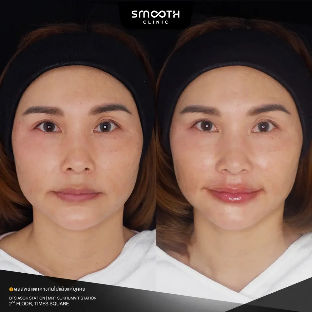 รีวิวฟิลเลอร์ปาก 2