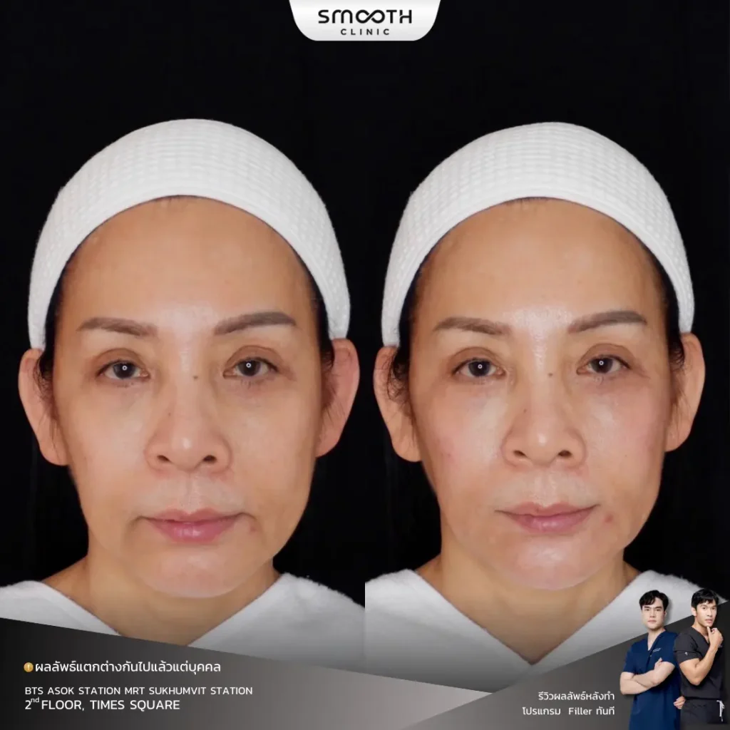 รีวิวฟิลเลอร์ร่องน้ำหมาก 1