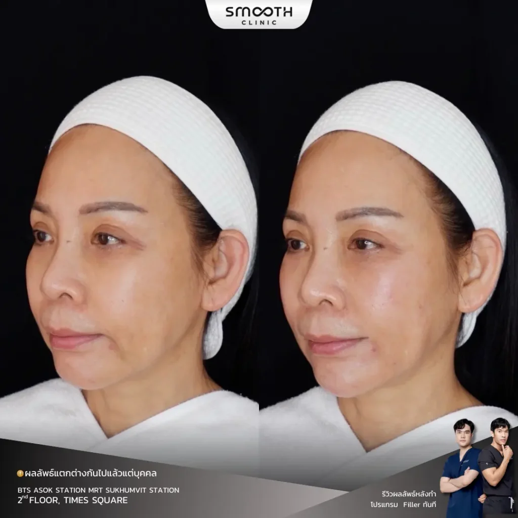 รีวิวฟิลเลอร์ร่องน้ำหมาก 3