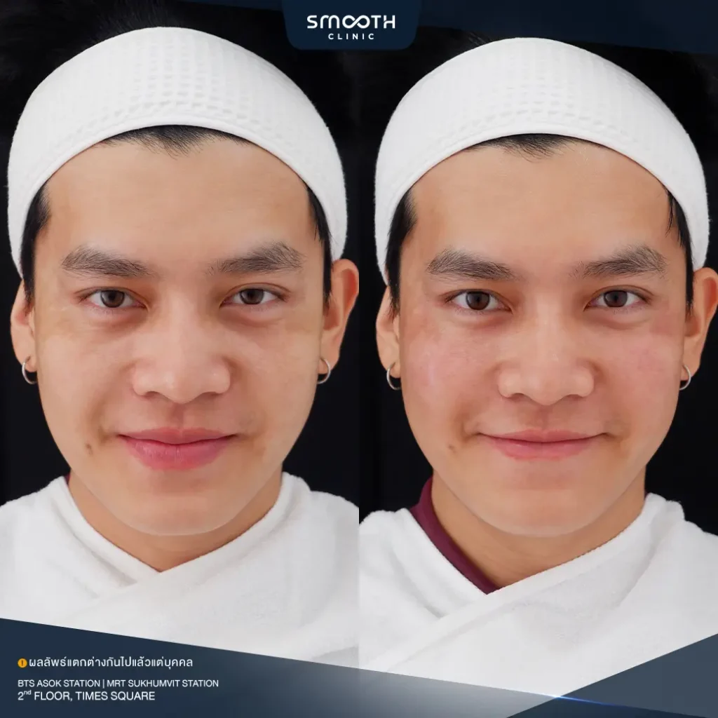 รีวิวฟิลเลอร์ร่องแก้ม 1