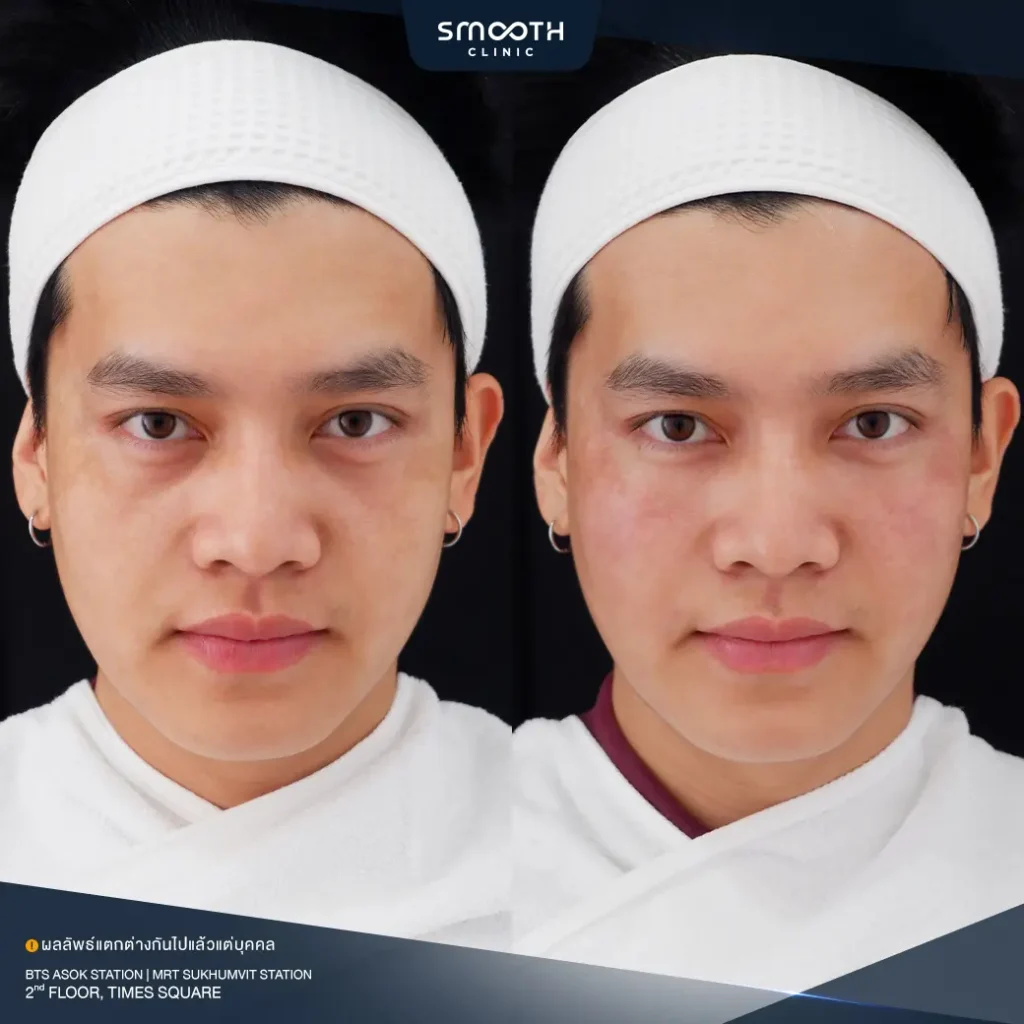 รีวิวฟิลเลอร์ร่องแก้ม 2