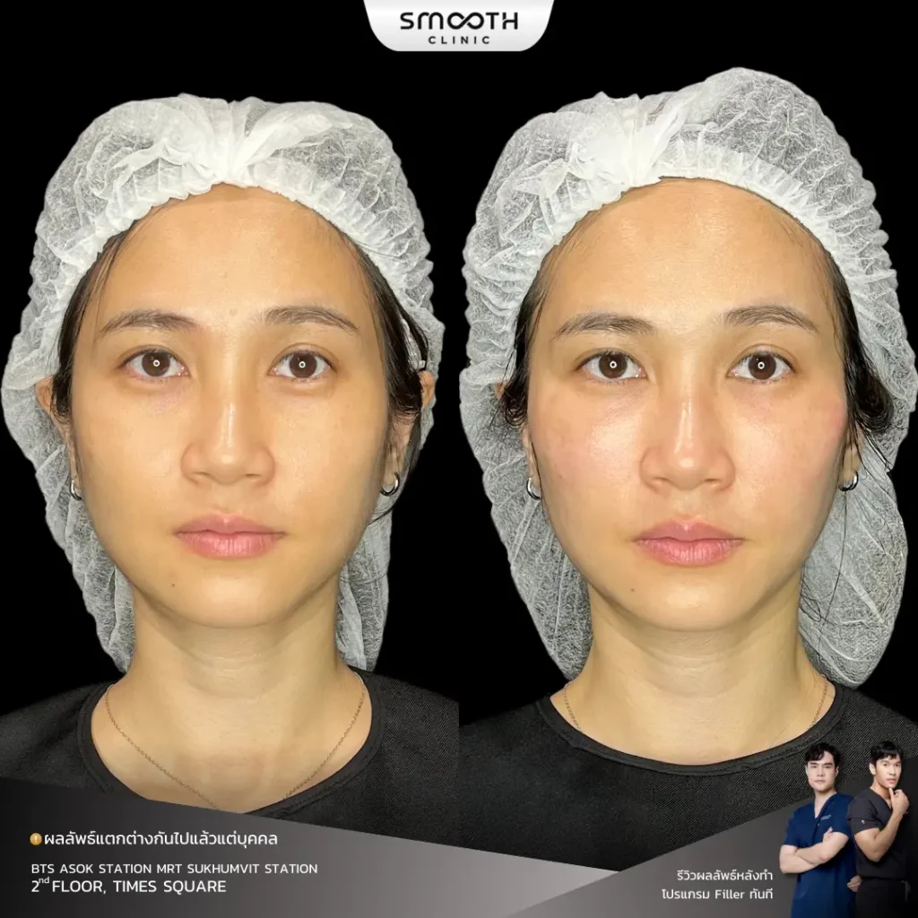 รีวิวฟิลเลอร์ใต้ตา 1