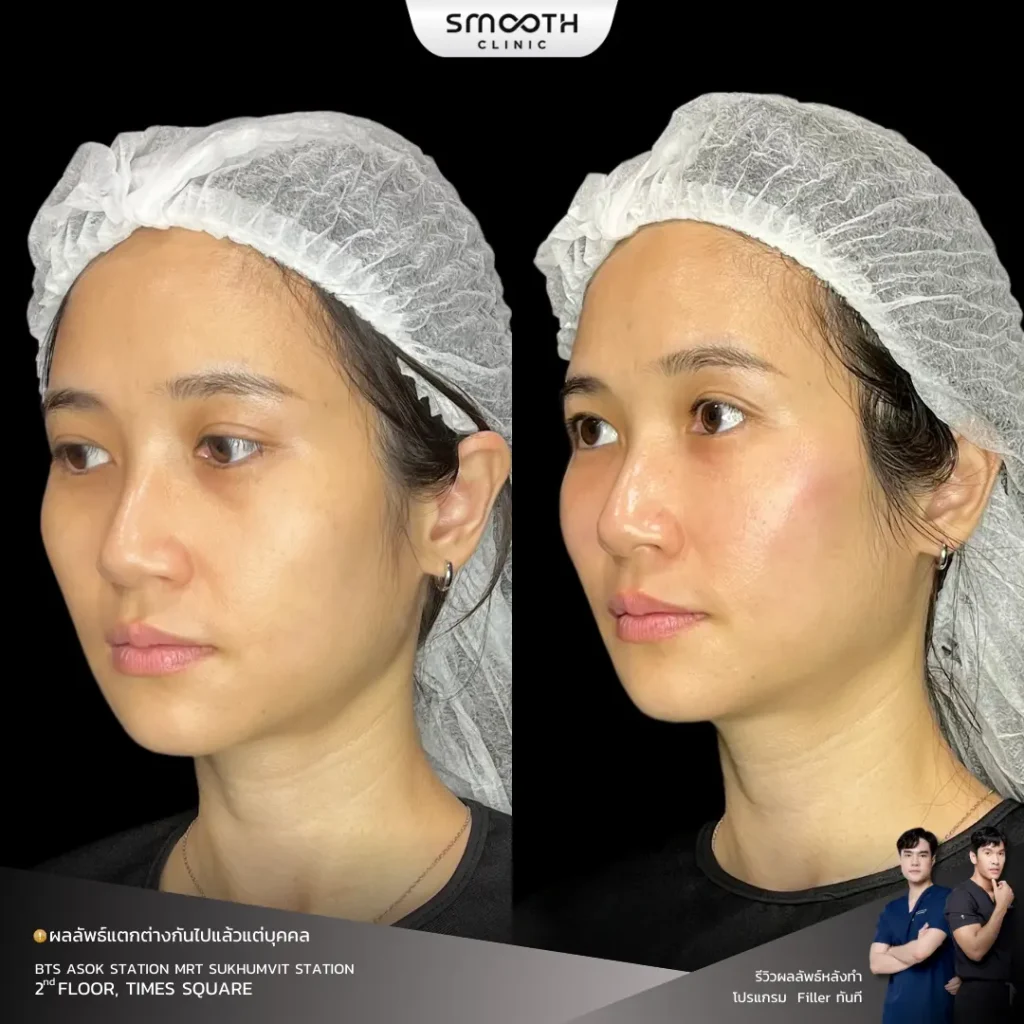 รีวิวฟิลเลอร์ใต้ตา 2