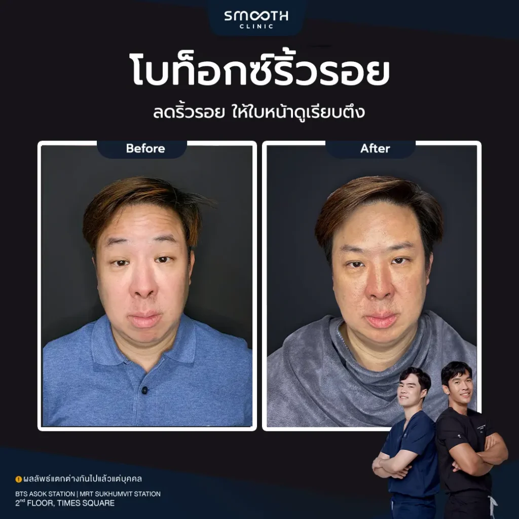 รีวิวโบท็อกซ์ริ้วรอย 1