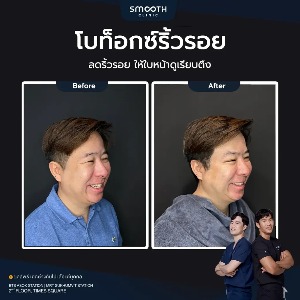 รีวิวโบท็อกซ์ริ้วรอย 2