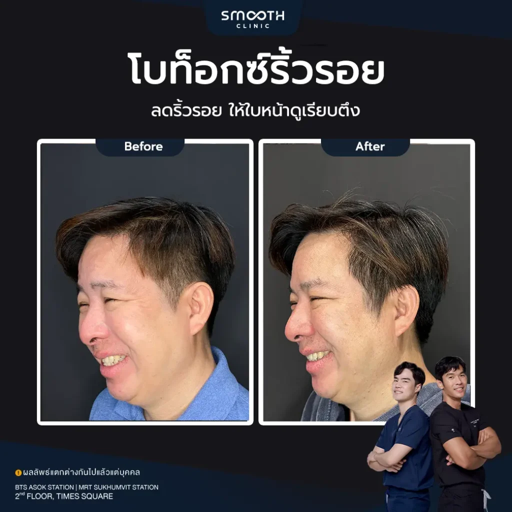 รีวิวโบท็อกซ์ริ้วรอย 3