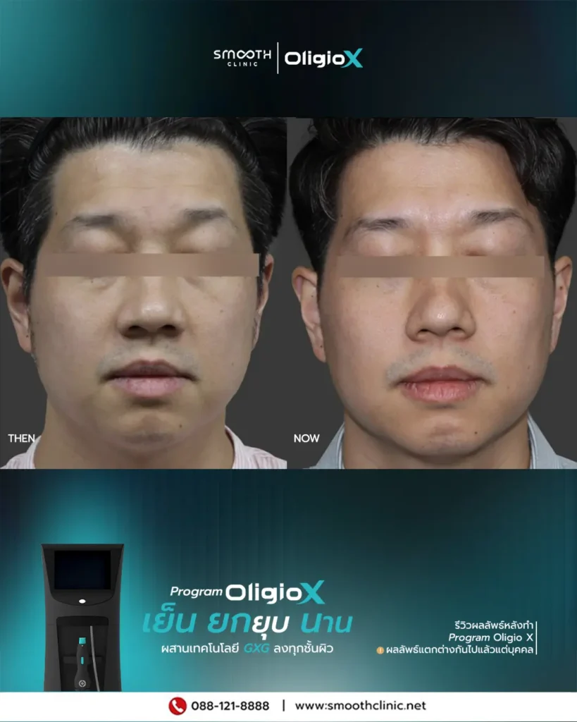 review q1 26 oligio x 2