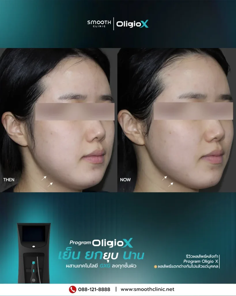 review q1 26 oligio x 3