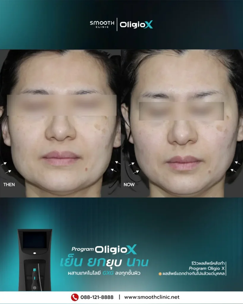 review q1 26 oligio x 4