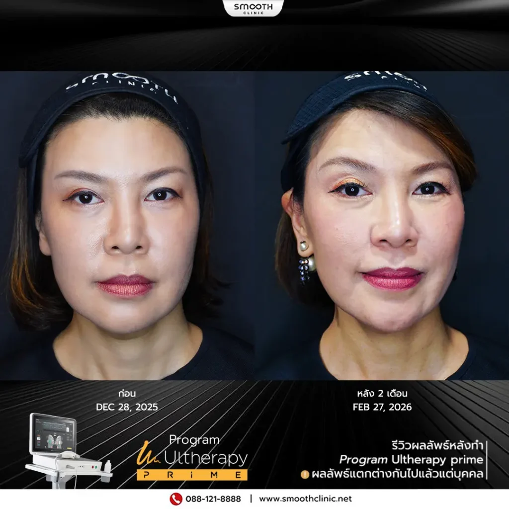 review q1 26 ultherapy prime 1