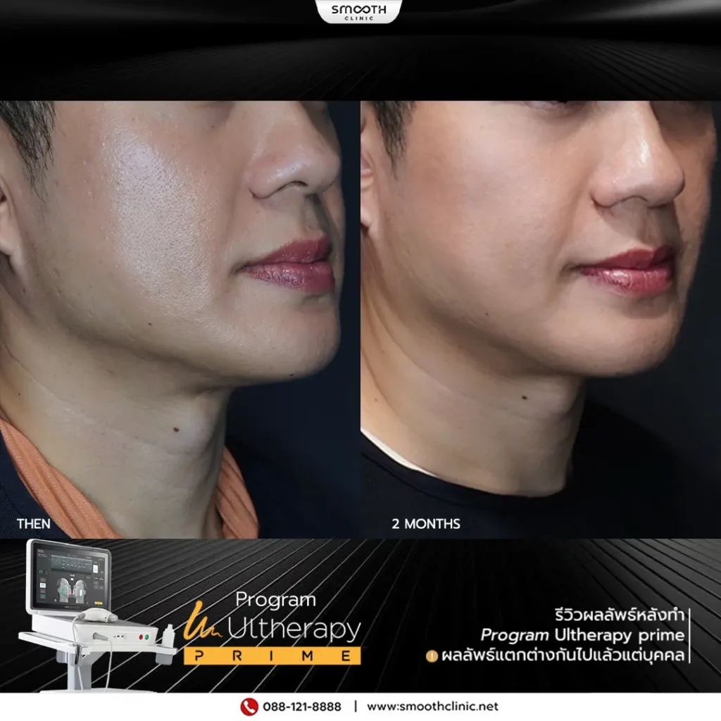 review q1 26 ultherapy prime 13
