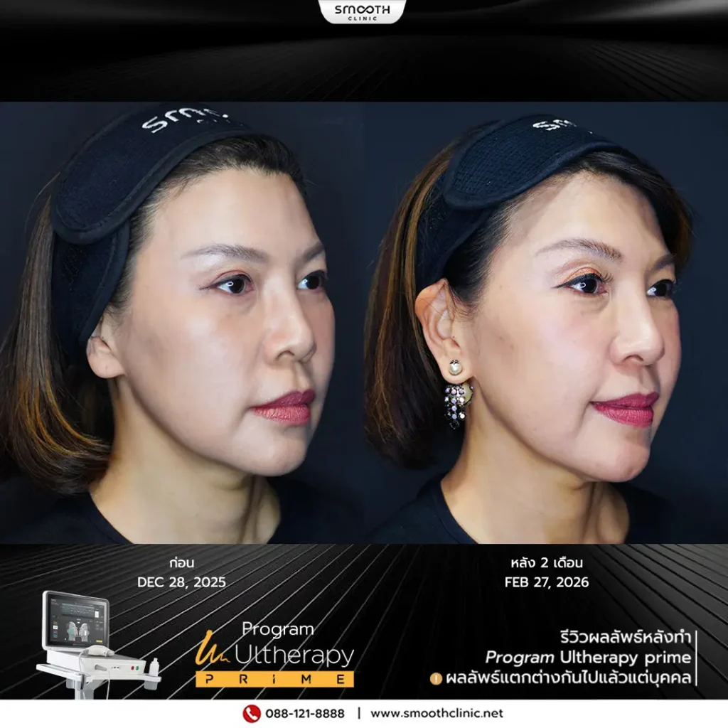 review q1 26 ultherapy prime 2