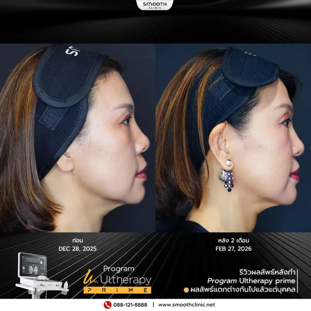 review q1 26 ultherapy prime 3