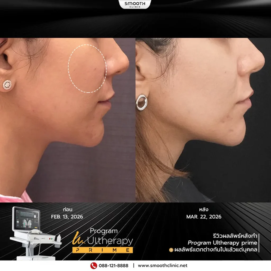 review q1 26 ultherapy prime 5