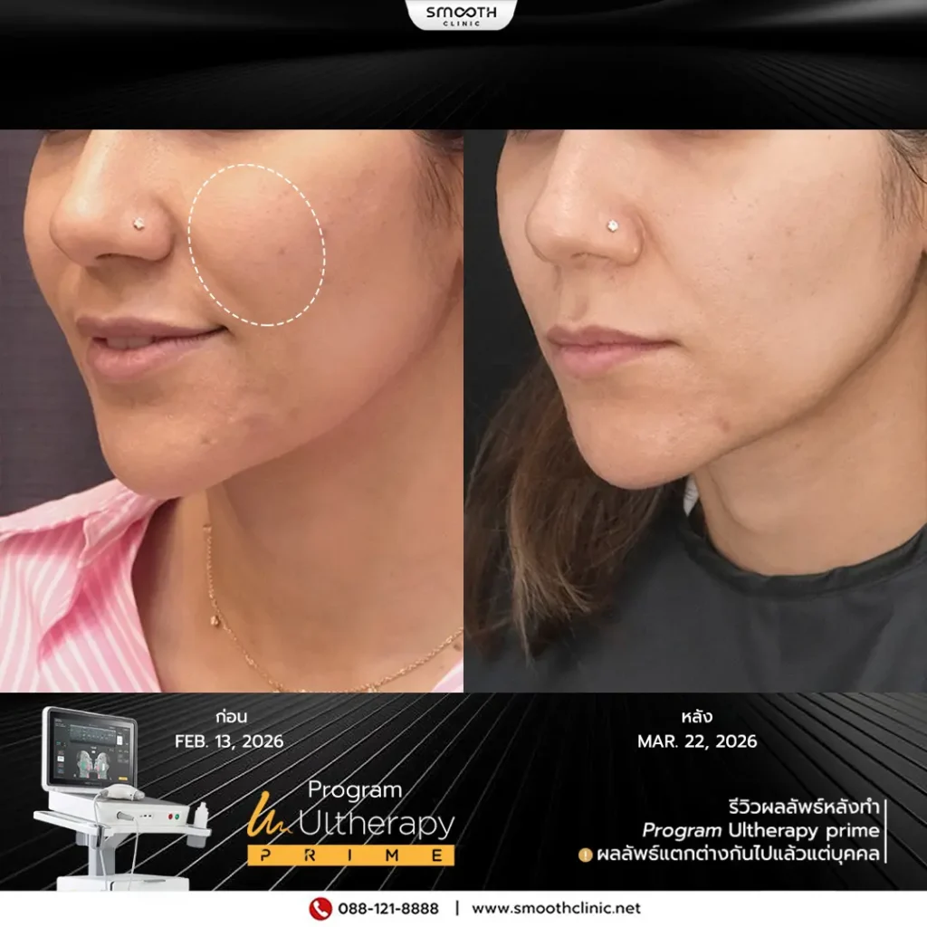 review q1 26 ultherapy prime 6