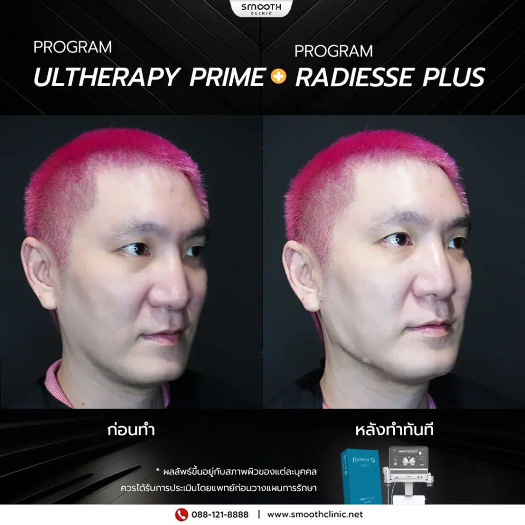 review q1 26 ultherapy prime 9