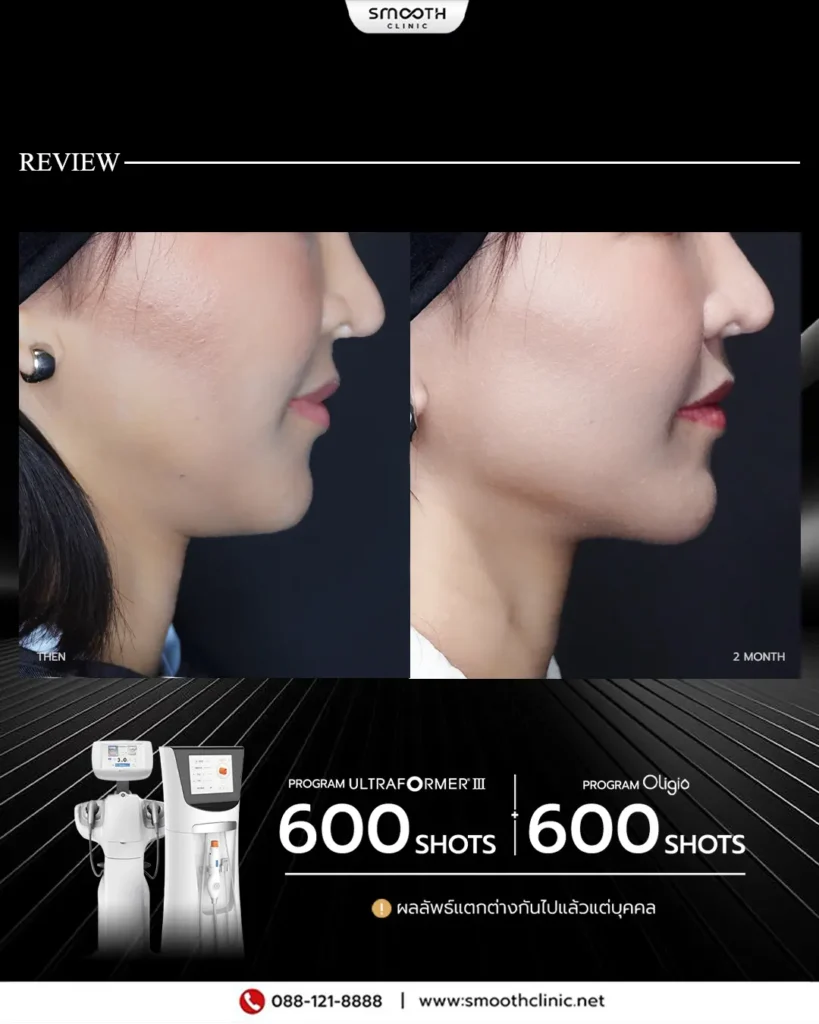 review q1 26 ultraformer 2